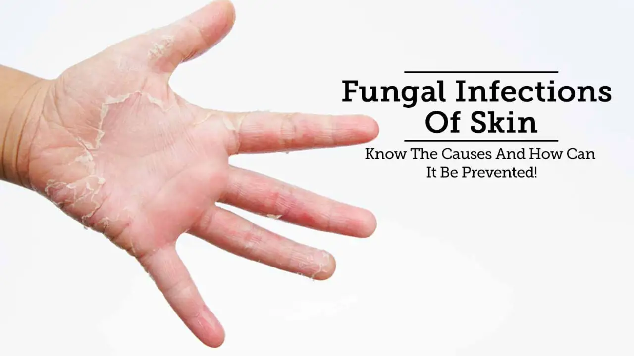The Impact of Fungal Infections on Joint Health and Mobility