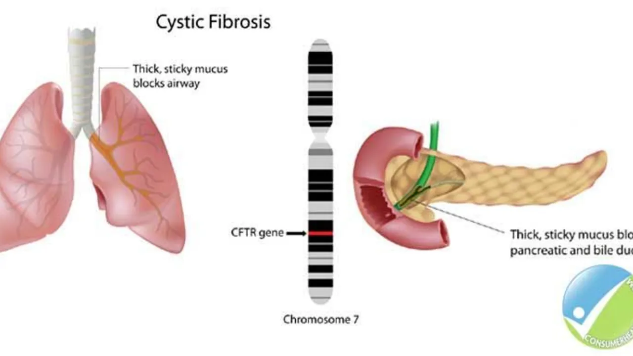 The Role of Ursodeoxycholic Acid in the Management of Cystic Fibrosis-Related Liver Disease