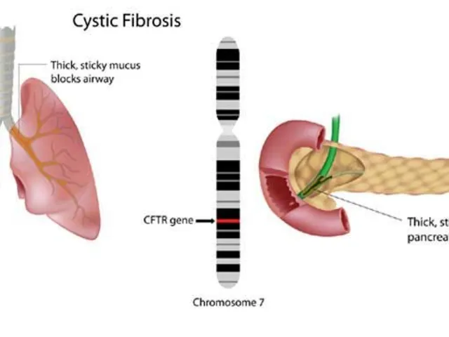 The Role of Ursodeoxycholic Acid in the Management of Cystic Fibrosis-Related Liver Disease